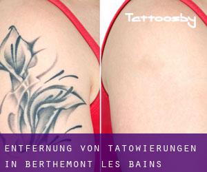 Entfernung von Tätowierungen in Berthemont-les-Bains
