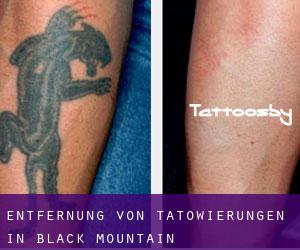 Entfernung von Tätowierungen in Black Mountain