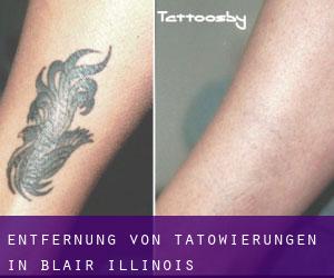 Entfernung von Tätowierungen in Blair (Illinois)