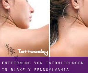 Entfernung von Tätowierungen in Blakely (Pennsylvania)