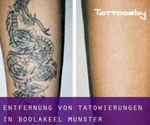 Entfernung von Tätowierungen in Boolakeel (Munster)