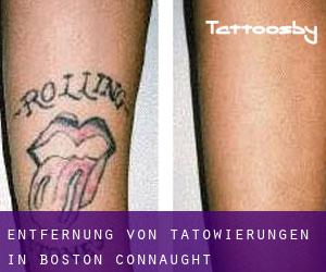 Entfernung von Tätowierungen in Boston (Connaught)