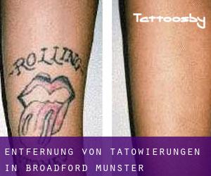 Entfernung von Tätowierungen in Broadford (Munster)