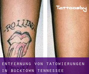 Entfernung von Tätowierungen in Bucktown (Tennessee)