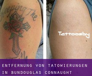 Entfernung von Tätowierungen in Bundouglas (Connaught)