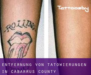 Entfernung von Tätowierungen in Cabarrus County