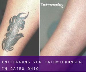 Entfernung von Tätowierungen in Cairo (Ohio)