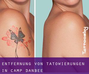 Entfernung von Tätowierungen in Camp Danbee