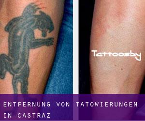 Entfernung von Tätowierungen in Castraz