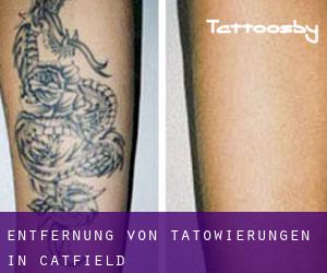 Entfernung von Tätowierungen in Catfield