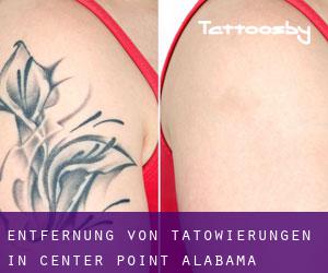 Entfernung von Tätowierungen in Center Point (Alabama)