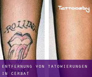 Entfernung von Tätowierungen in Cerbat