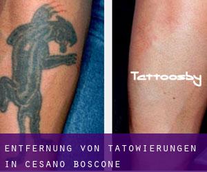 Entfernung von Tätowierungen in Cesano Boscone