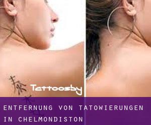 Entfernung von Tätowierungen in Chelmondiston