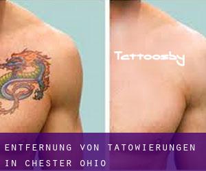 Entfernung von Tätowierungen in Chester (Ohio)