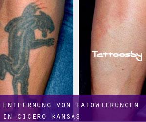 Entfernung von Tätowierungen in Cicero (Kansas)