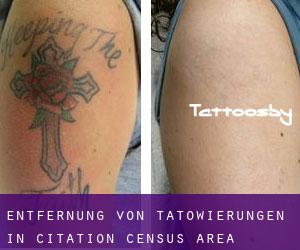 Entfernung von Tätowierungen in Citation (census area)