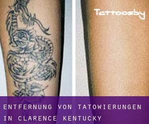 Entfernung von Tätowierungen in Clarence (Kentucky)