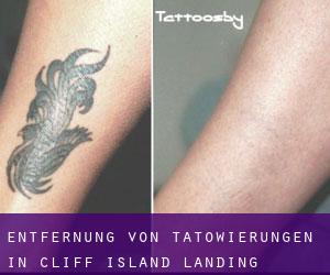 Entfernung von Tätowierungen in Cliff Island Landing