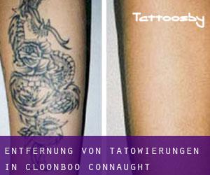 Entfernung von Tätowierungen in Cloonboo (Connaught)