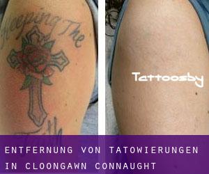 Entfernung von Tätowierungen in Cloongawn (Connaught)