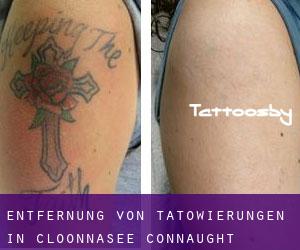 Entfernung von Tätowierungen in Cloonnasee (Connaught)