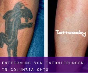 Entfernung von Tätowierungen in Columbia (Ohio)