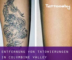 Entfernung von Tätowierungen in Columbine Valley