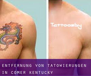 Entfernung von Tätowierungen in Comer (Kentucky)