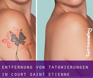 Entfernung von Tätowierungen in Court-Saint-Étienne