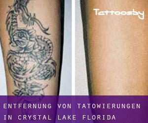 Entfernung von Tätowierungen in Crystal Lake (Florida)