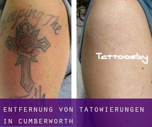 Entfernung von Tätowierungen in Cumberworth