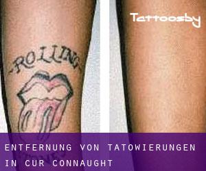 Entfernung von Tätowierungen in Cur (Connaught)