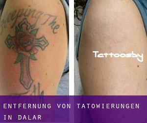 Entfernung von Tätowierungen in Dalar