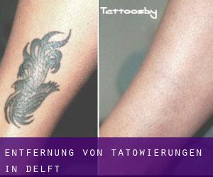 Entfernung von Tätowierungen in Delft