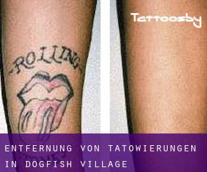 Entfernung von Tätowierungen in Dogfish Village