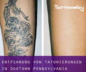 Entfernung von Tätowierungen in Dogtown (Pennsylvania)