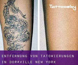 Entfernung von Tätowierungen in Doraville (New York)