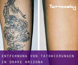 Entfernung von Tätowierungen in Drake (Arizona)