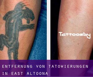 Entfernung von Tätowierungen in East Altoona