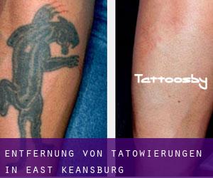 Entfernung von Tätowierungen in East Keansburg