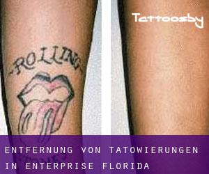 Entfernung von Tätowierungen in Enterprise (Florida)