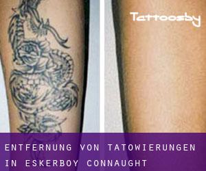 Entfernung von Tätowierungen in Eskerboy (Connaught)