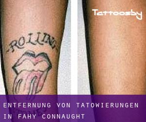 Entfernung von Tätowierungen in Fahy (Connaught)