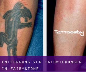 Entfernung von Tätowierungen in Fairystone