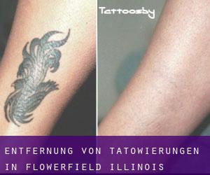 Entfernung von Tätowierungen in Flowerfield (Illinois)