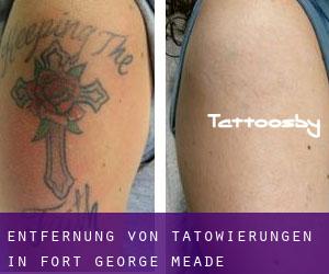 Entfernung von Tätowierungen in Fort George Meade