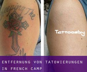 Entfernung von Tätowierungen in French Camp