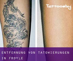 Entfernung von Tätowierungen in Froyle