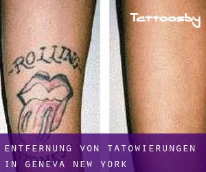 Entfernung von Tätowierungen in Geneva (New York)